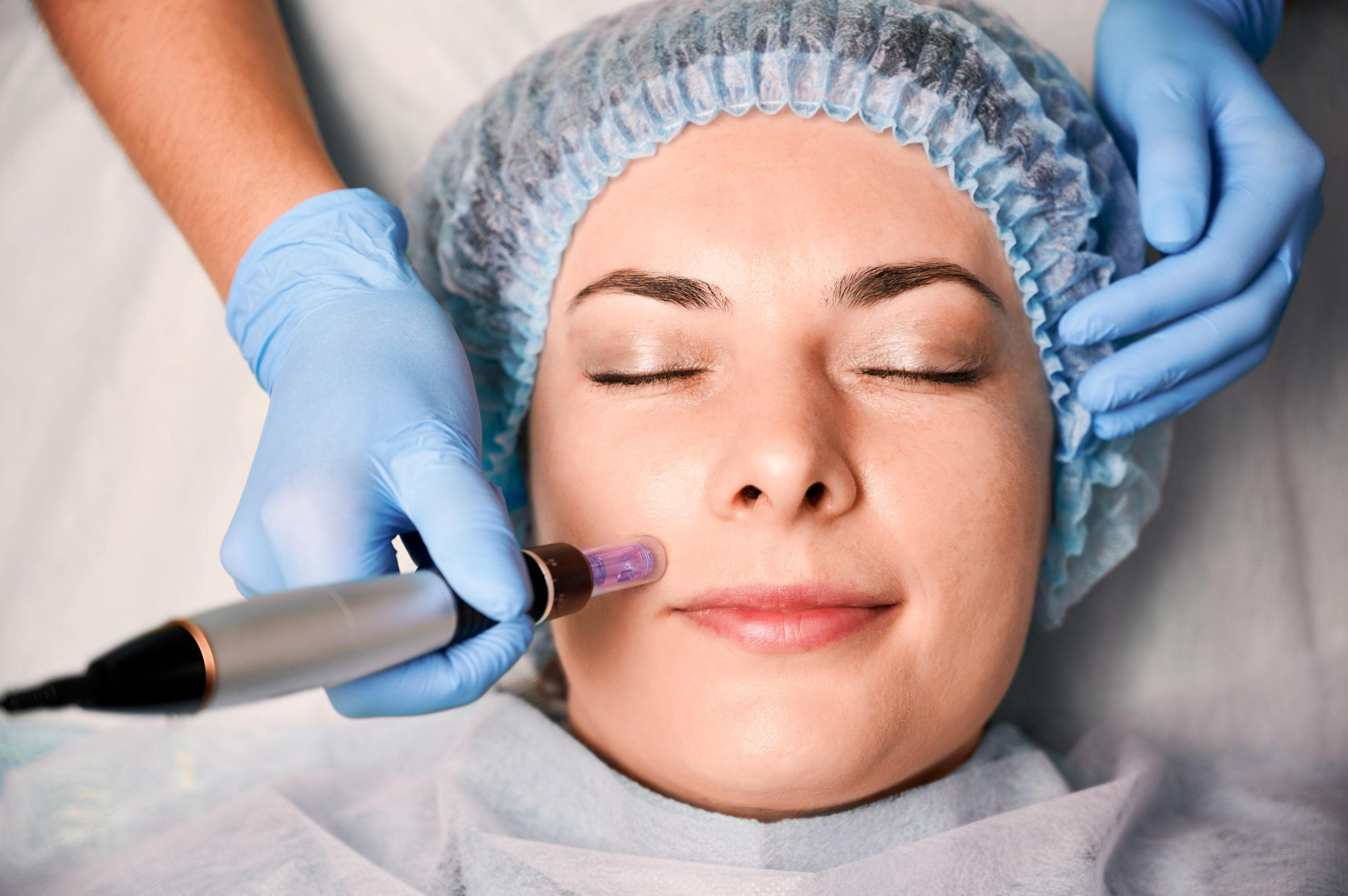 Transform Your Skin with PRP Microneedling: Expert Guide