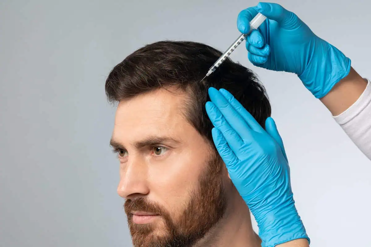 PRF for Hair Restoration by Eastside Aesthetics by Lena in Redmond, WA