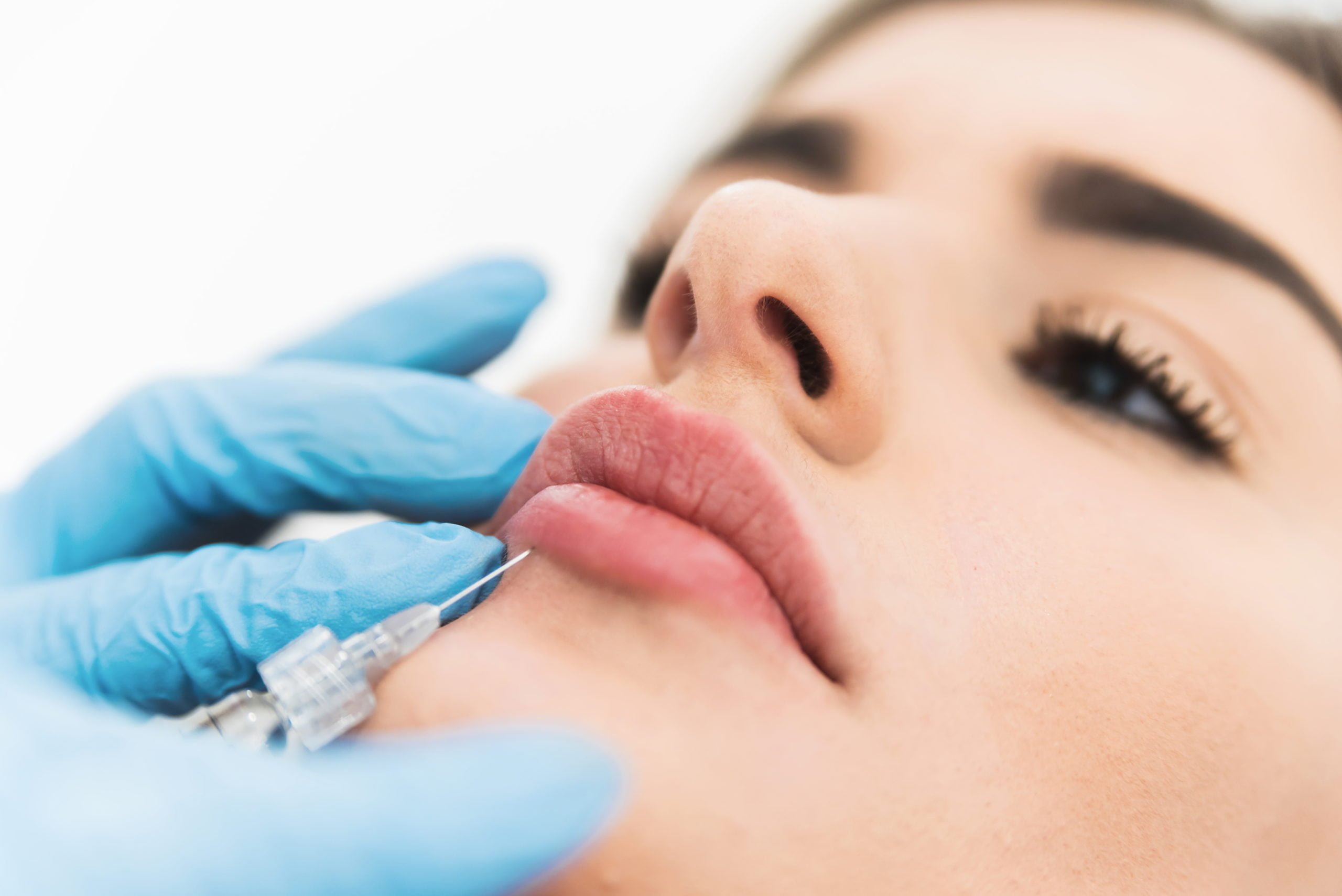 What is Hylenex Filler Reversal